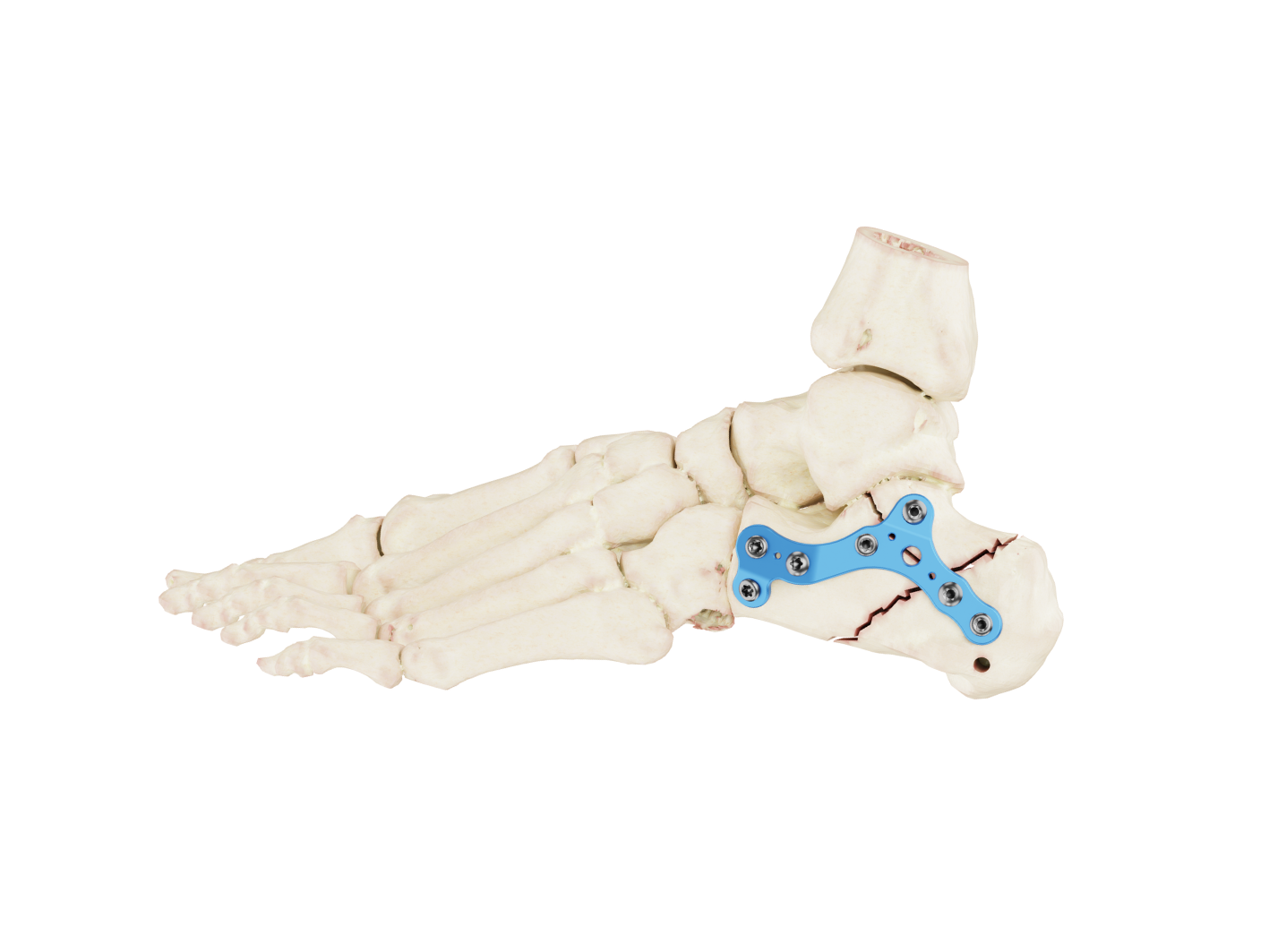 Affinity Calcáneo - Imagen 3