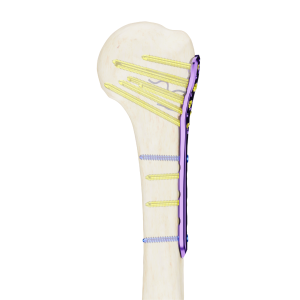 Affinity Húmero Proximal