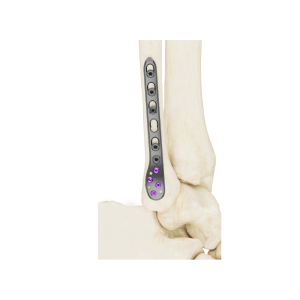 Affinity Peroné Distal