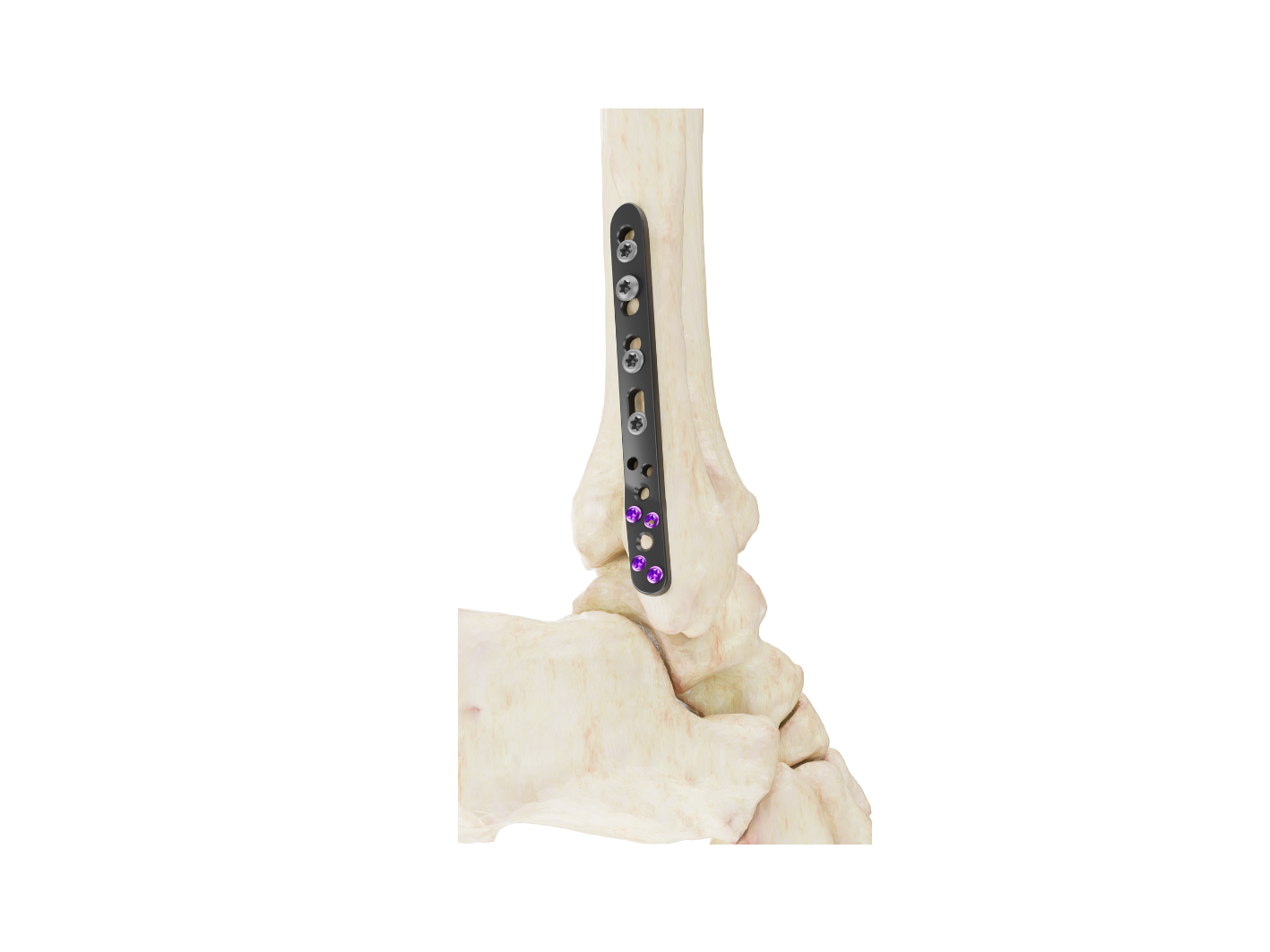 Affinity Peroné Distal - Imagen 2