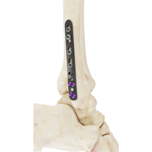 Placa Posterolateral Affinity Peroné Distal