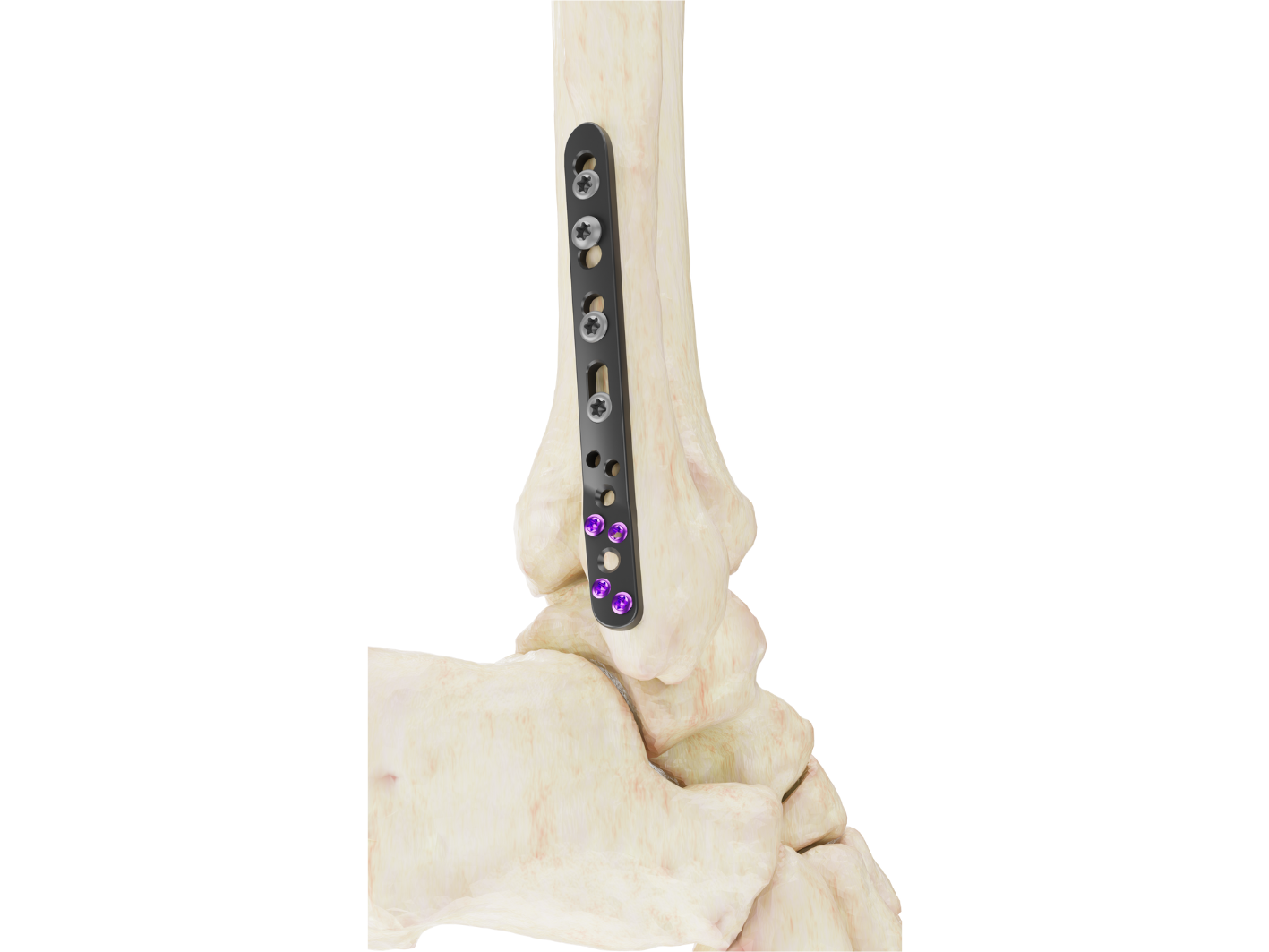 Placa Posterolateral Affinity Peroné Distal