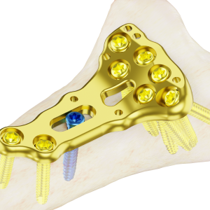 Affinity Radio Distal