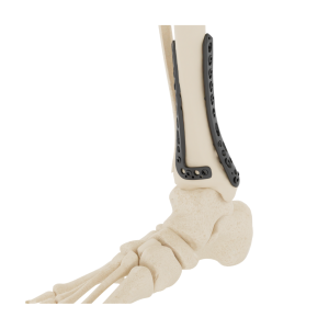 Affinity Tibia Distal