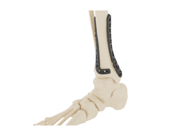Tibia Imr Affinity Tibia Distal – App Pedidos Sampedro