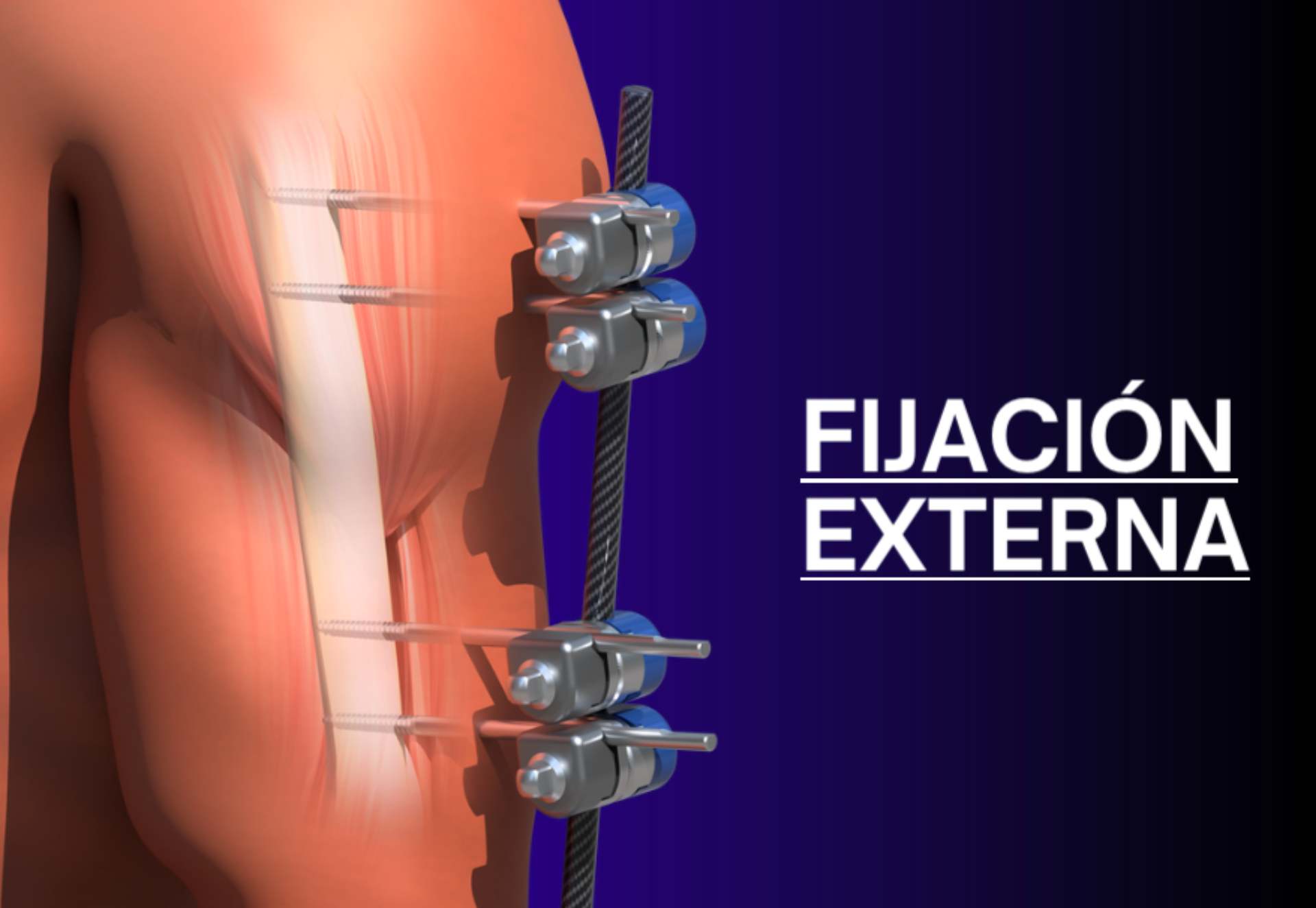 fijacion externa