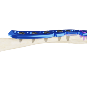 Anatómico de Clavícula