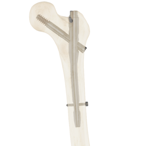 Clavo Support Fémur Proximal