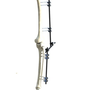 Fijación Externa Miembro Inferior