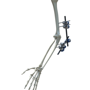 Fijación Externa Miembro Superior