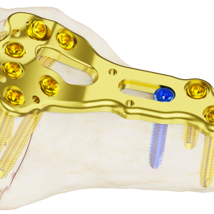 Placas Affinity Yuxtaarticular