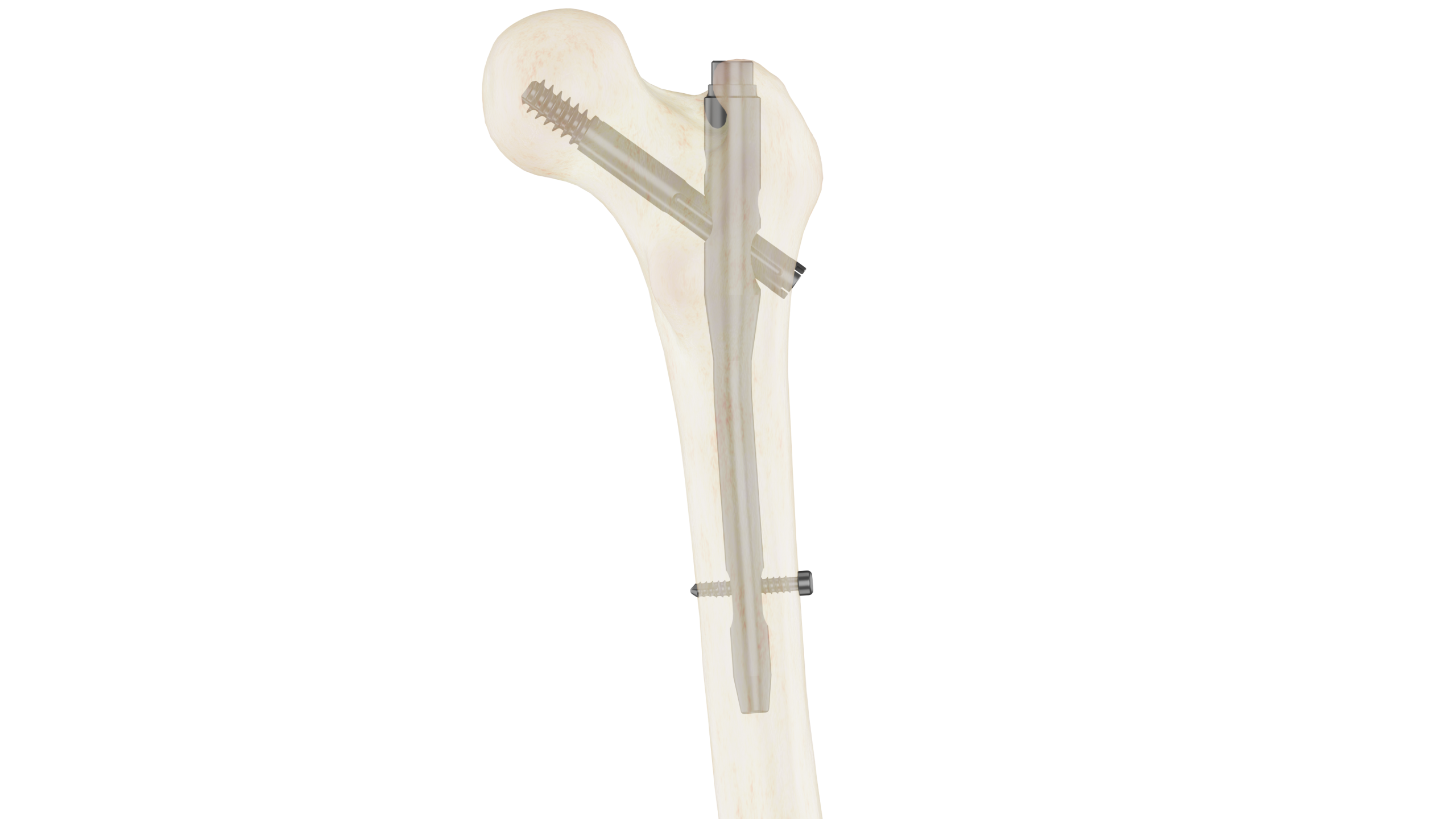 Clavo 10mm Support Fémur Proximal - Imagen 2