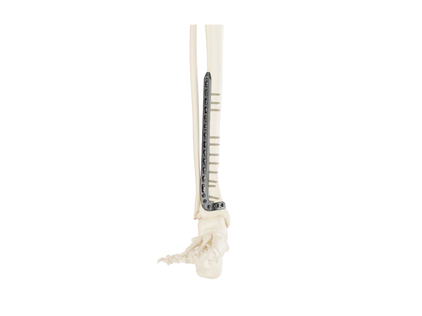 Placas Extralargas Affinity Tibia Distal - Imagen 3