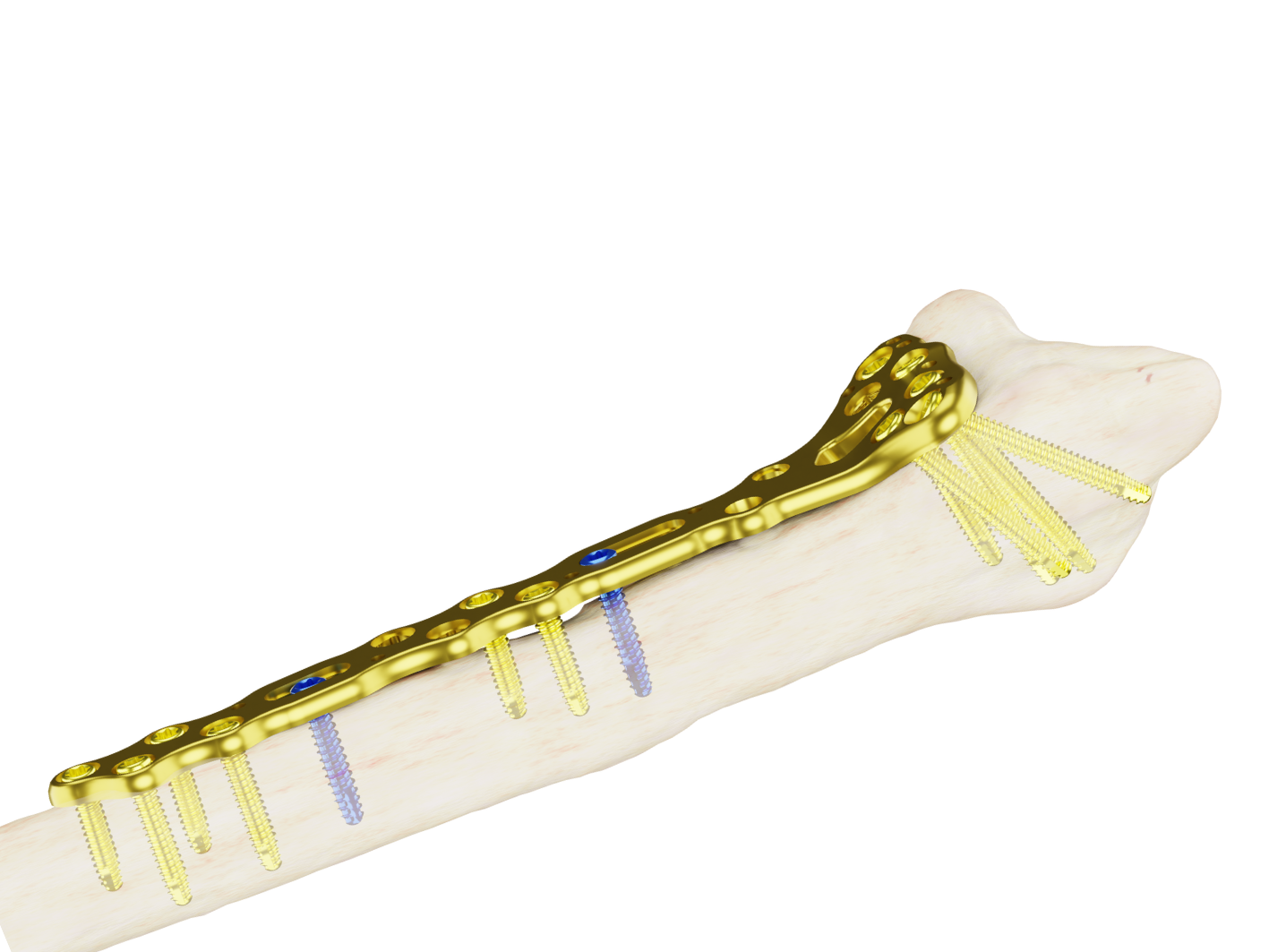 Placa Extralarga Affinity Radio Distal