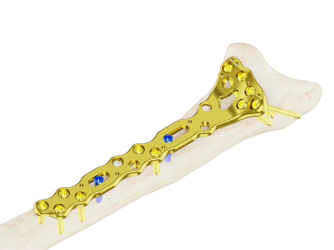 Placa Extralarga Affinity Radio Distal - Imagen 2