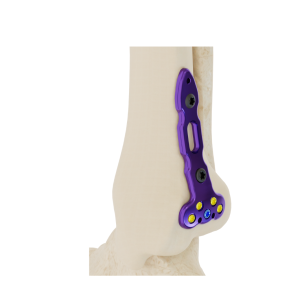 Placa Affinity Maléolo Posterior Tibia Distal