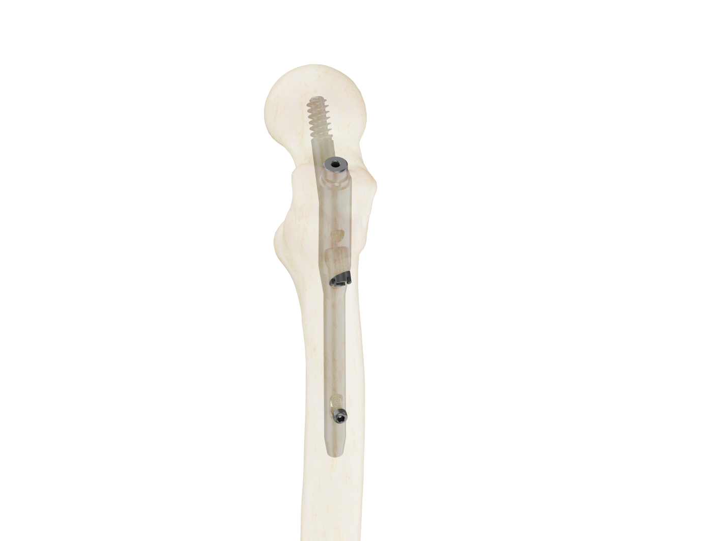 Clavo 10mm Support Fémur Proximal