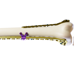 Affinity Fémur Distal